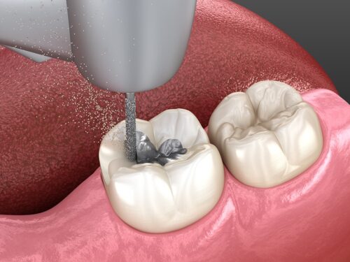 Amalgam removing and preparation for ceramic crown placement