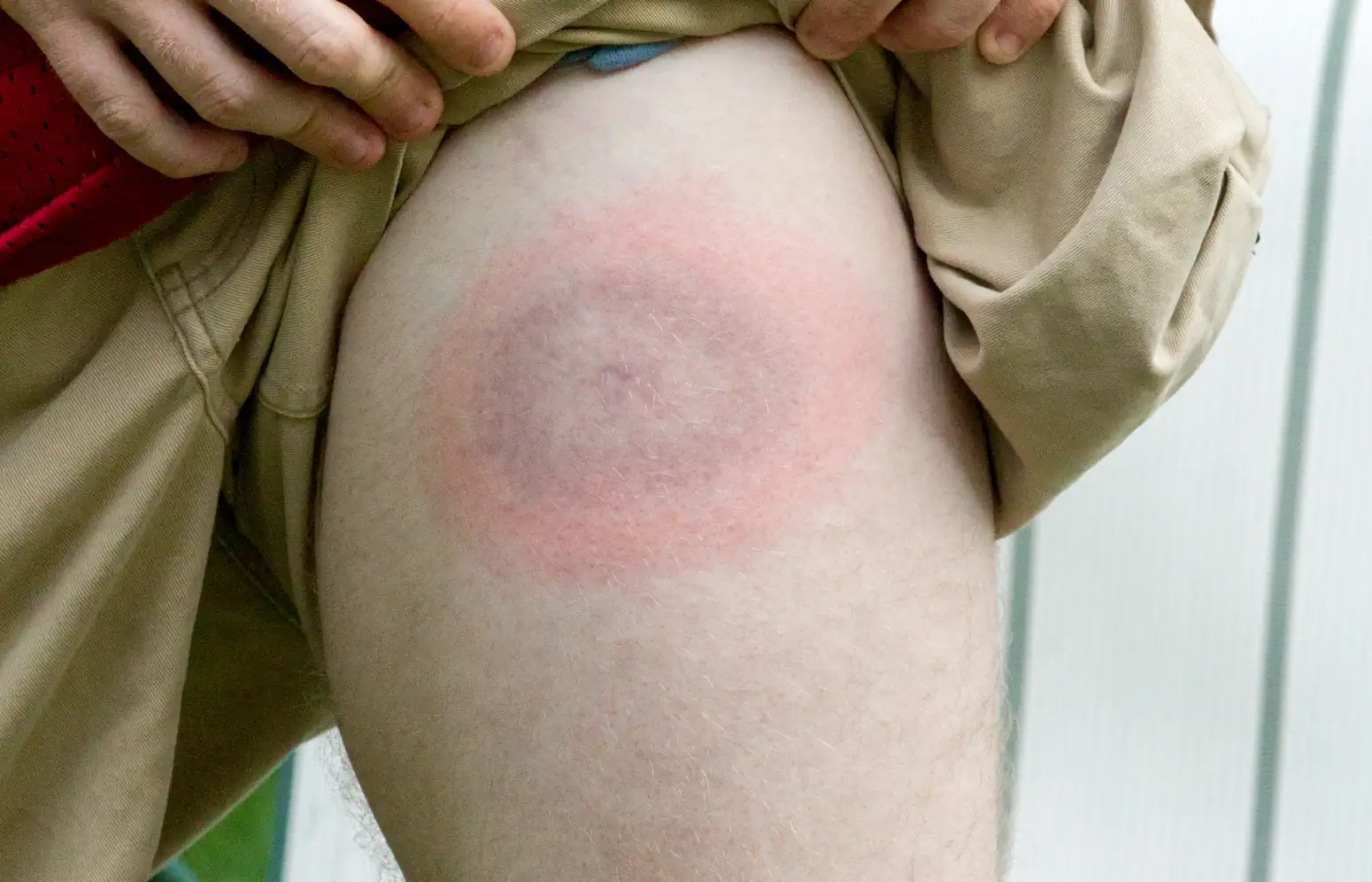Lyme disease can appear as a bullseye ring on skin but not always. Some people miss the ring altogether.